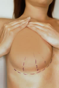 Best Gummy Bear Breast Implants San Antonio, TX