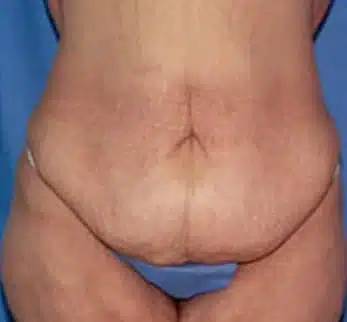 Before abdominoplasty abdominoplasty